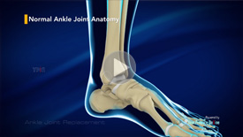 Ankle Joint Replacement