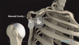 Arthroscopic Bankart Repair