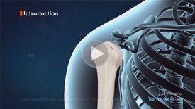 Glenoid Fractures