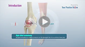 Tibial Eminence Spine Avulsions