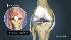 Knee Ligament Reconstruction