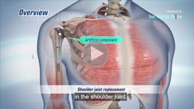 Minimally Invasive Shoulder Joint Replacement