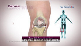 Knee Osteoarthritis