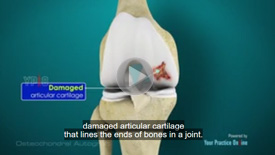 Osteochondritis Dissecans