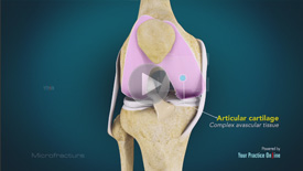 Osteonecrosis of the Knee