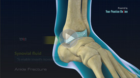 Plantar Fasciitis