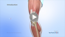 Subchondroplasty