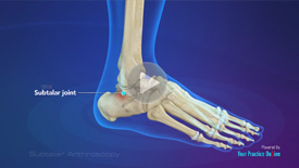 Subtalar Arthrodesis