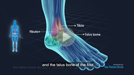 Ankle Ligament Injury