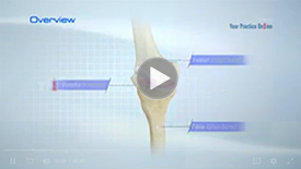 Total Knee Replacement