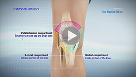 Patella Fracture